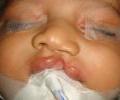 CLEFT